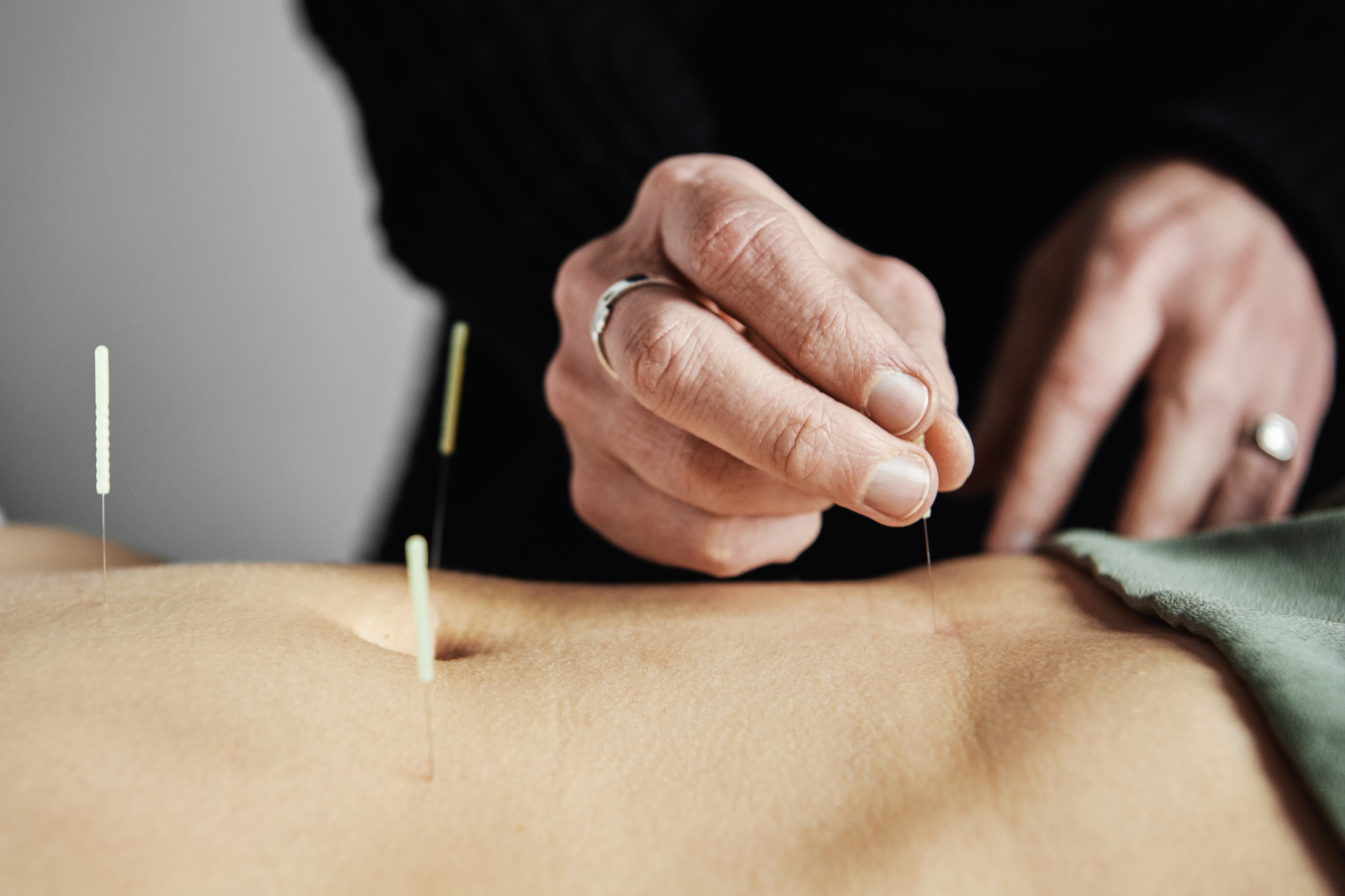 Understanding Acupuncture for Back Pain: An Effective Alternative Treatment.