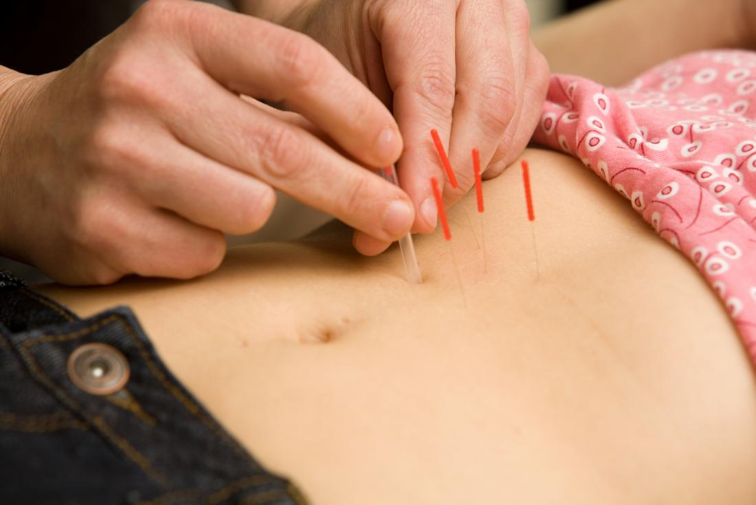 How Acupuncture Can Complement Your IVF Treatment and Improve Results.