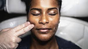 Why should I consider a chemical peel?