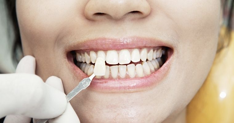 What Are Denture Veneers?
