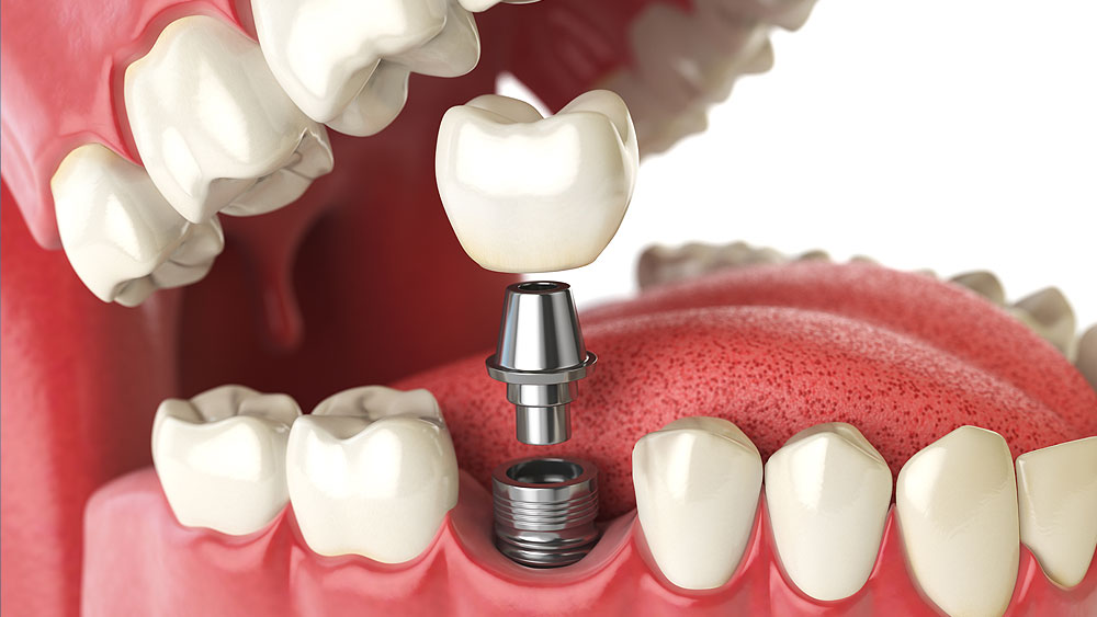 How to Find an Affordable Dental Implant?
