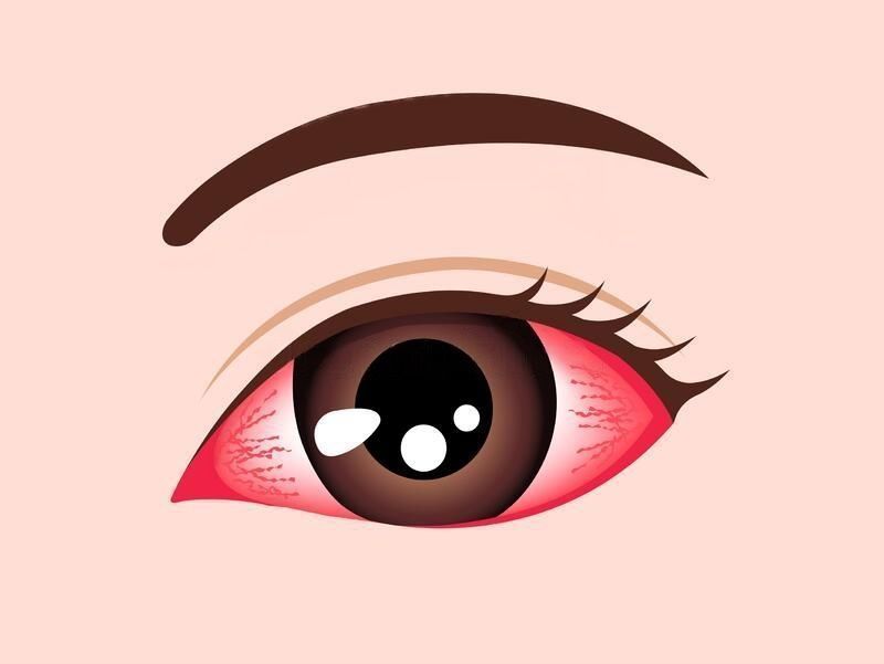 Pink eye (conjunctivitis) - Symptoms and causes