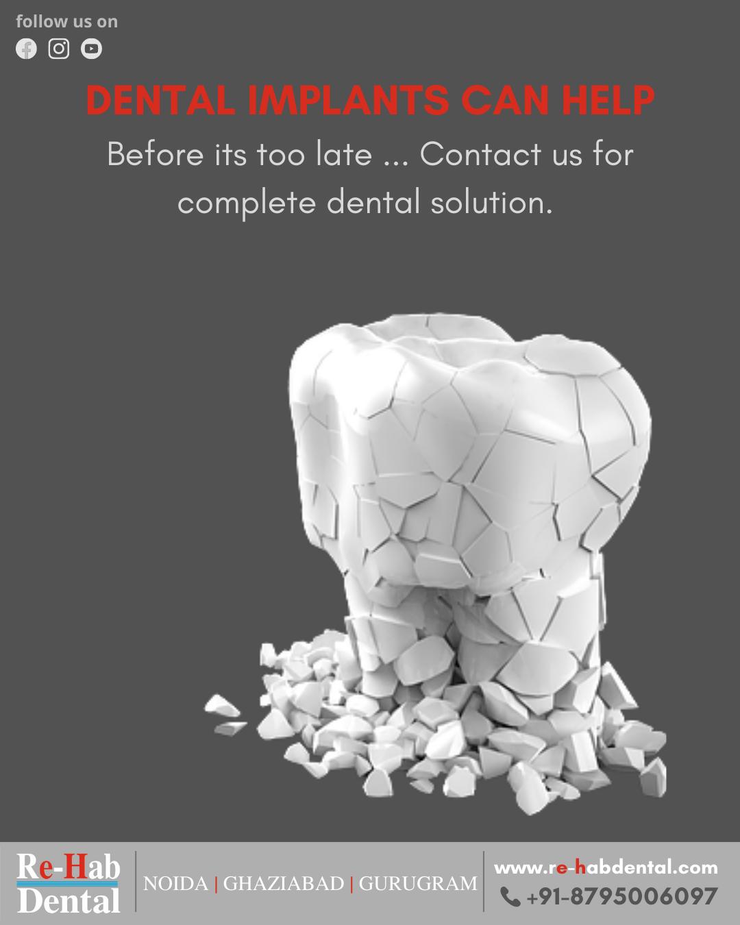 What Makes Re-Hab Dental Clinic The Best Dental Implant Clinic In Noida