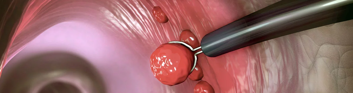 Colonoscopy Screening- What You Need to Know Before You Get One?