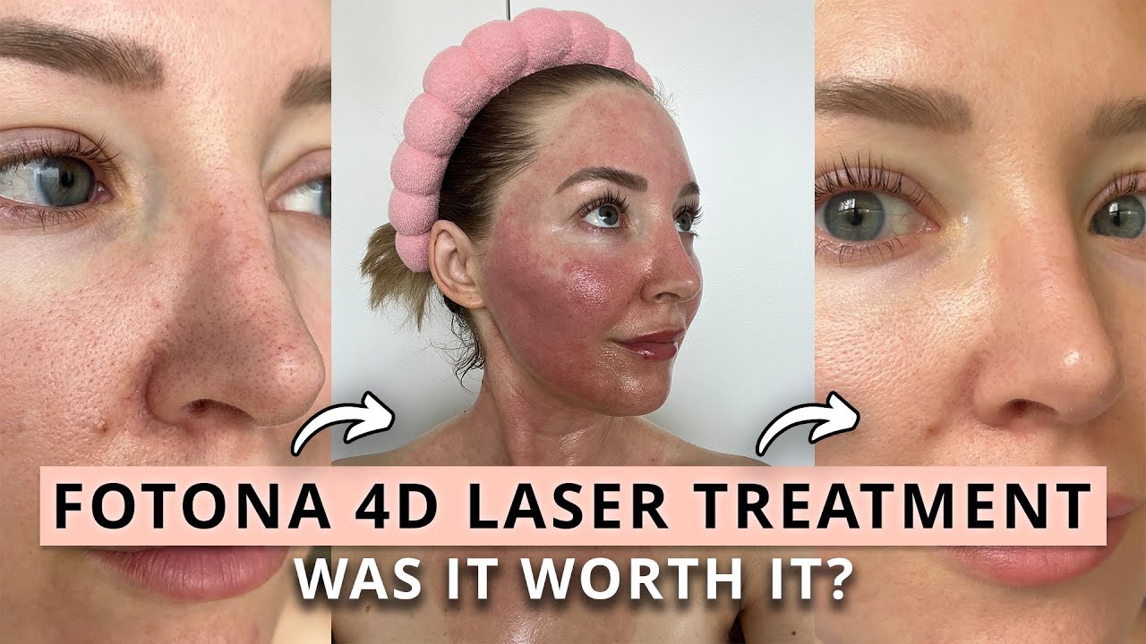 Exploring the Fotona 4D Neck Lift: Does It Deliver Promised Results?
