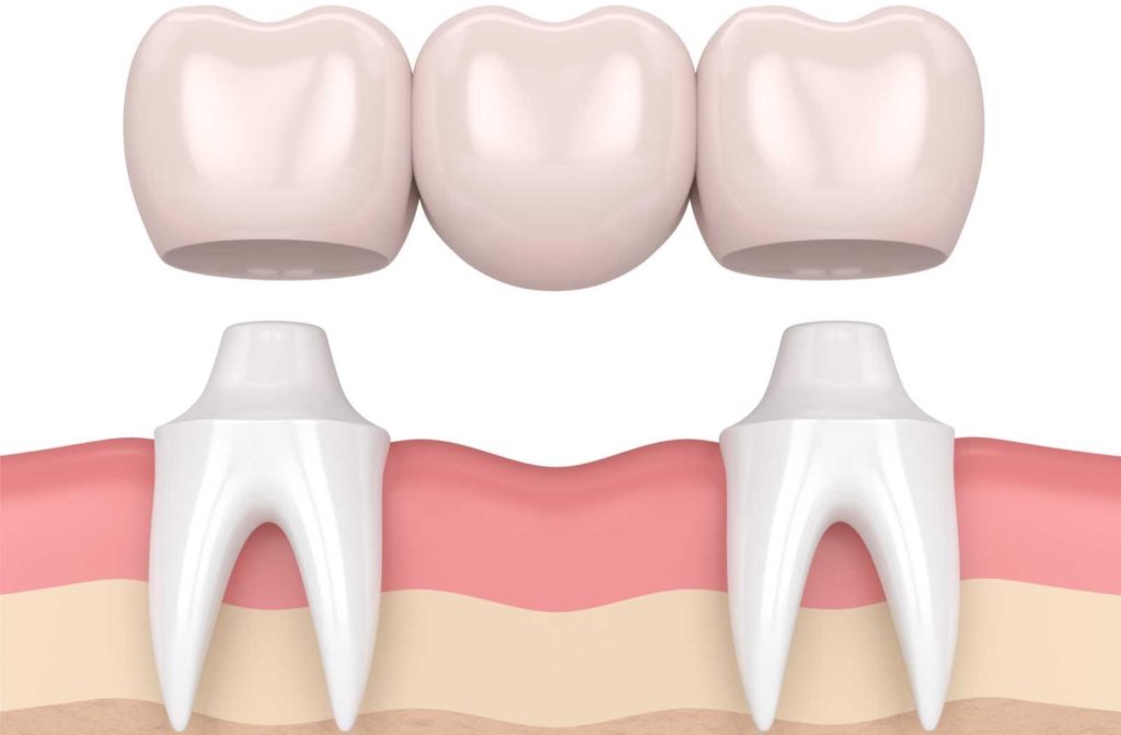 Dental Bridges: Who Needs Them, Types, Costs