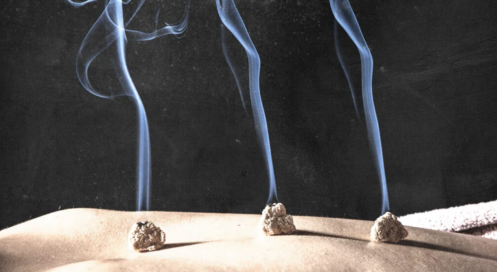 Attilio D'Alberto Shares Professional Moxibustion Techniques and Benefits