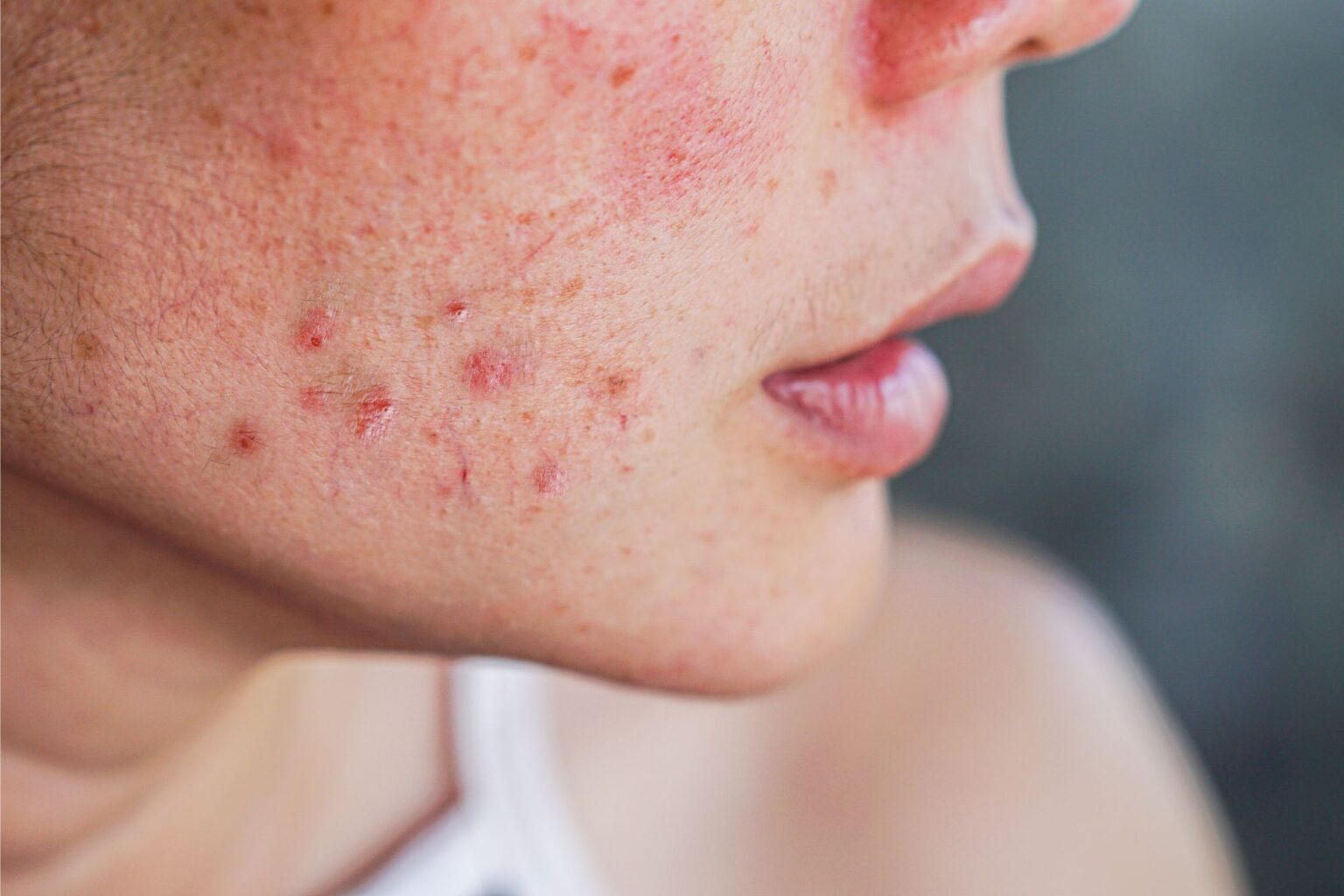 best pimple spot treatment kuchai lama