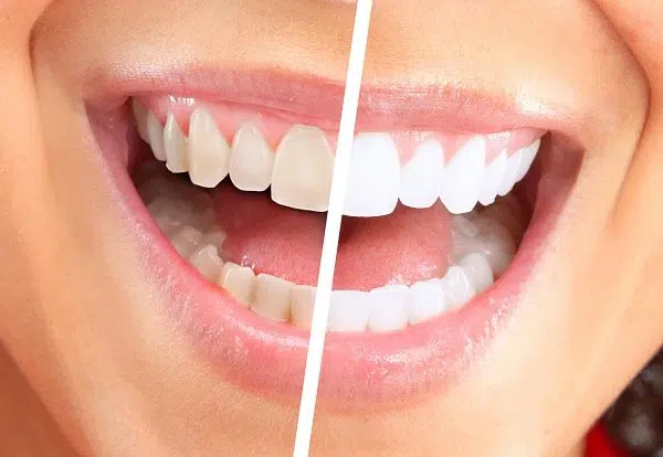 Important Things To Know Before Whitening Your Teeth