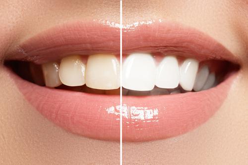 What can You Achieve through Teeth Whitening?