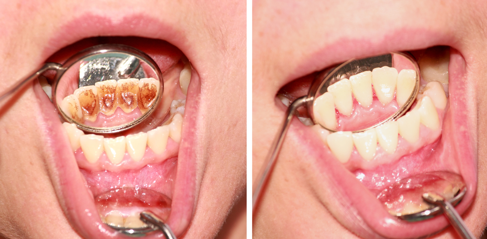Get Rid Of Tartar Build-Up Right Away!
