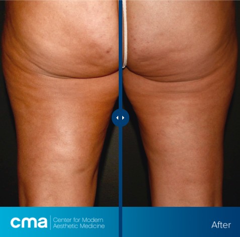 Tips for promoting the Cellulite Treatment: