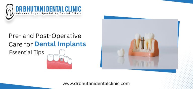Pre- and Post-Operative Care for Dental Implants: Essential Tips
