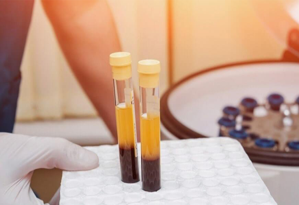 PRP Treatment in Dubai