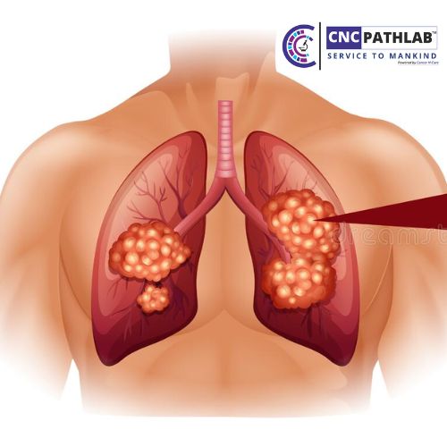 Best Lung Cancer Treatment In Delhi