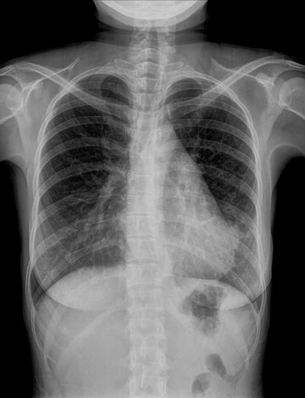 HCS home collection services - X-ray at home in Hyderabad