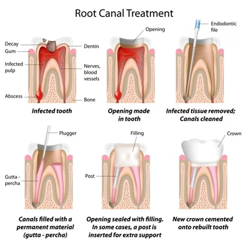 5 Common Myths About Root canals