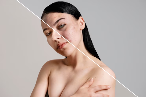 NYC's Top Laser Treatment for Acne Scars: What You Need to Know