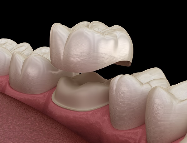 Different Stages of Root Canal Treatment: Step-by-Step Guide