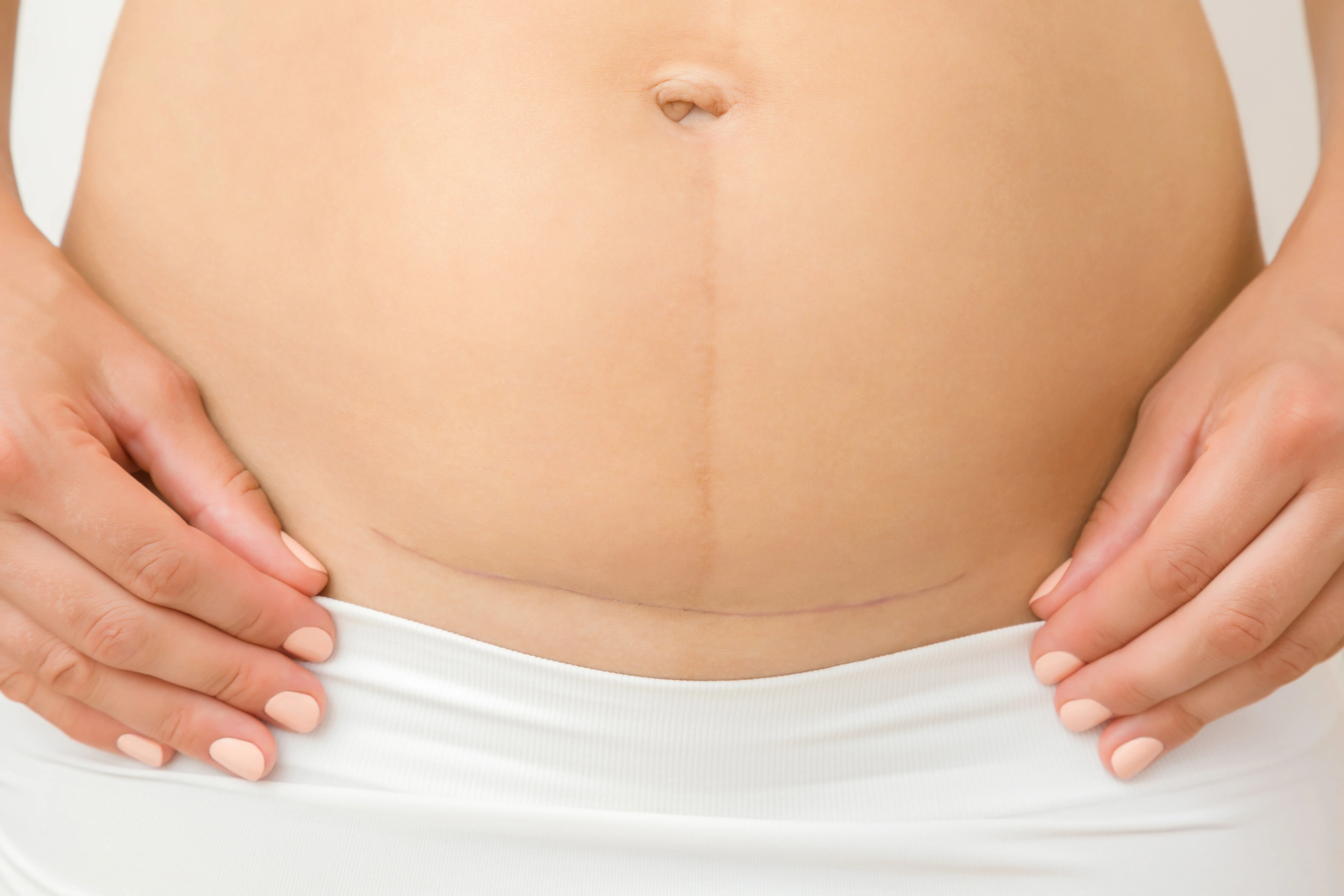 Caesarean Section Preparation and Recovery