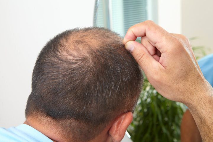  FUE vs. FUT Hair Transplant - What Are the Differences?