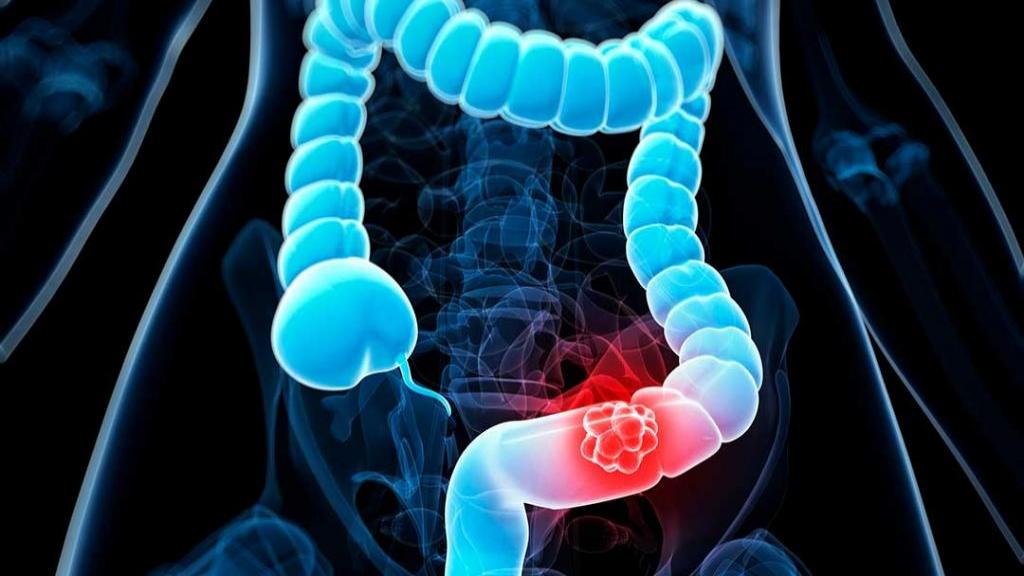 Colorectal Cancer Screening Market Growth: Expanding Screening Access