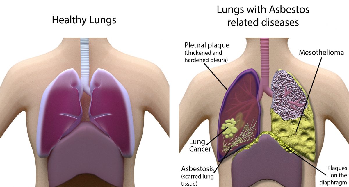 Exploring Advanced Therapies in the Pleural Diseases Market