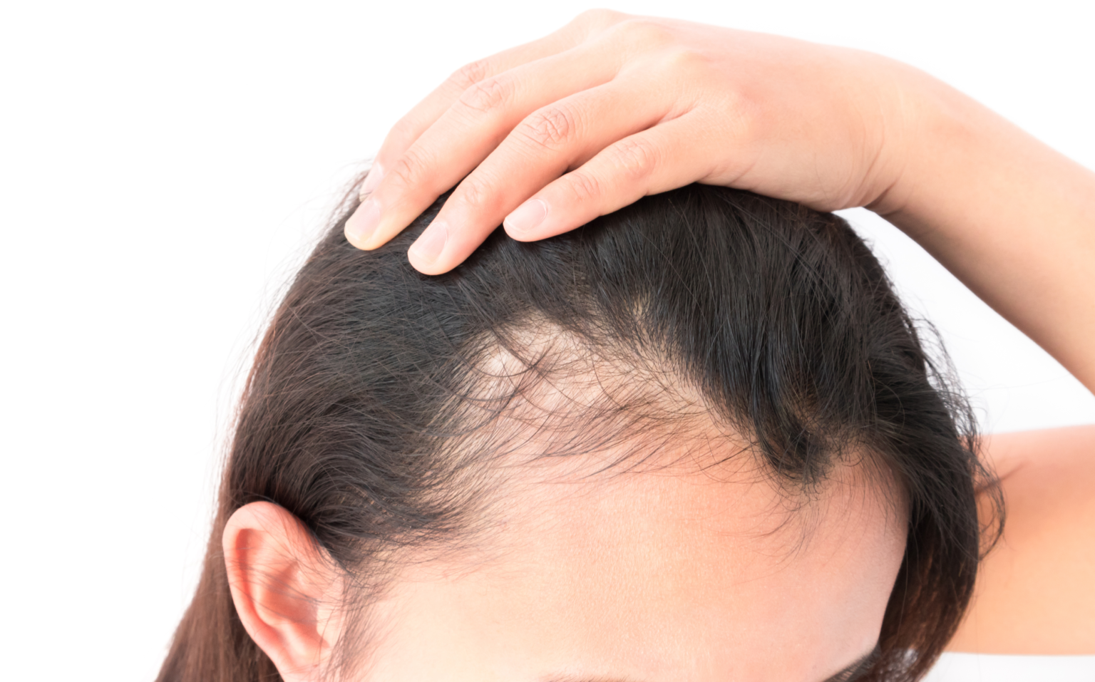 Navigating the Alopecia Treatment Market: Consumer Preferences