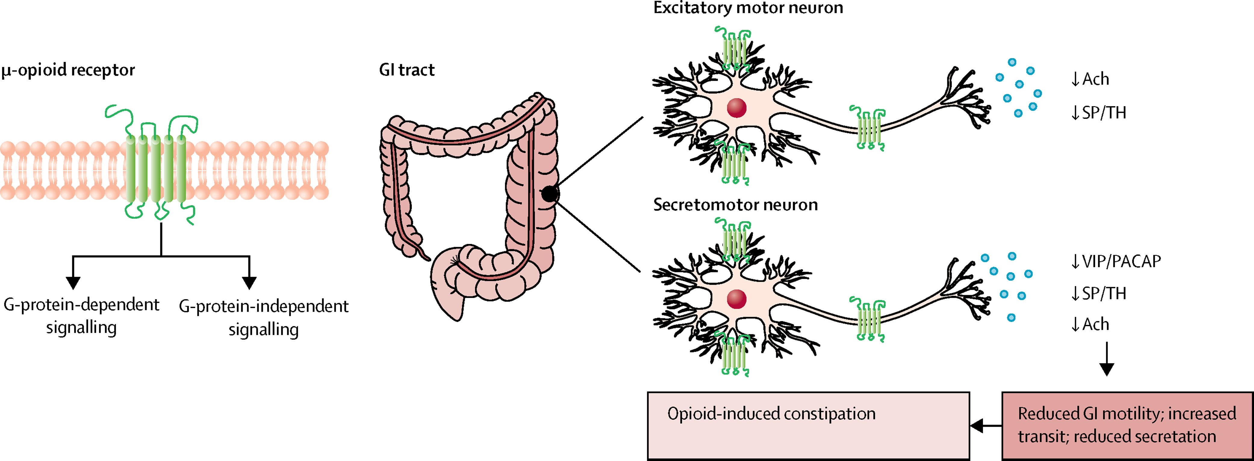 Opioid Induced Constipation Treatment Market: Targeted Therapies for Opioid Users