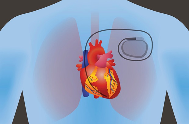 Cardiac Pacemaker Market Report: Comprehensive Assessment