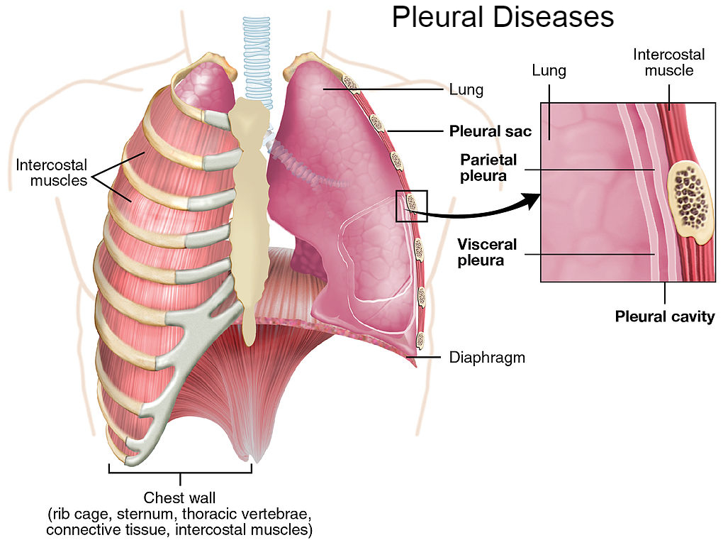 Pleural Diseases: Addressing the Challenges of Thoracic Health