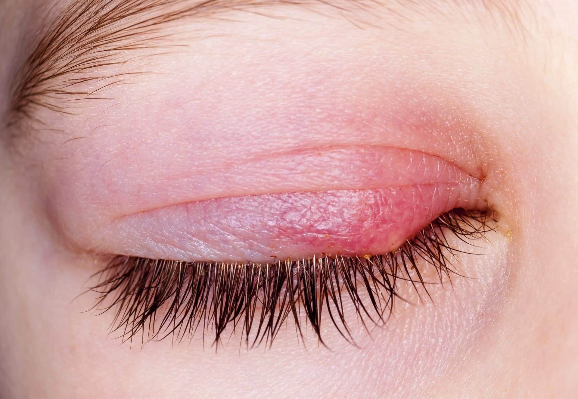 Blepharitis Treatment Market: Shaping the Future of Lid Inflammation Management