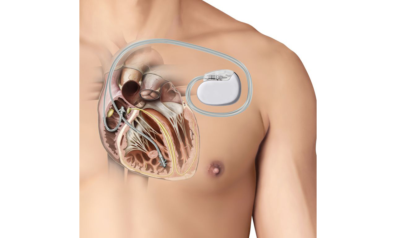 Active Implantable Medical Devices Market Forecast: Projections and Trends