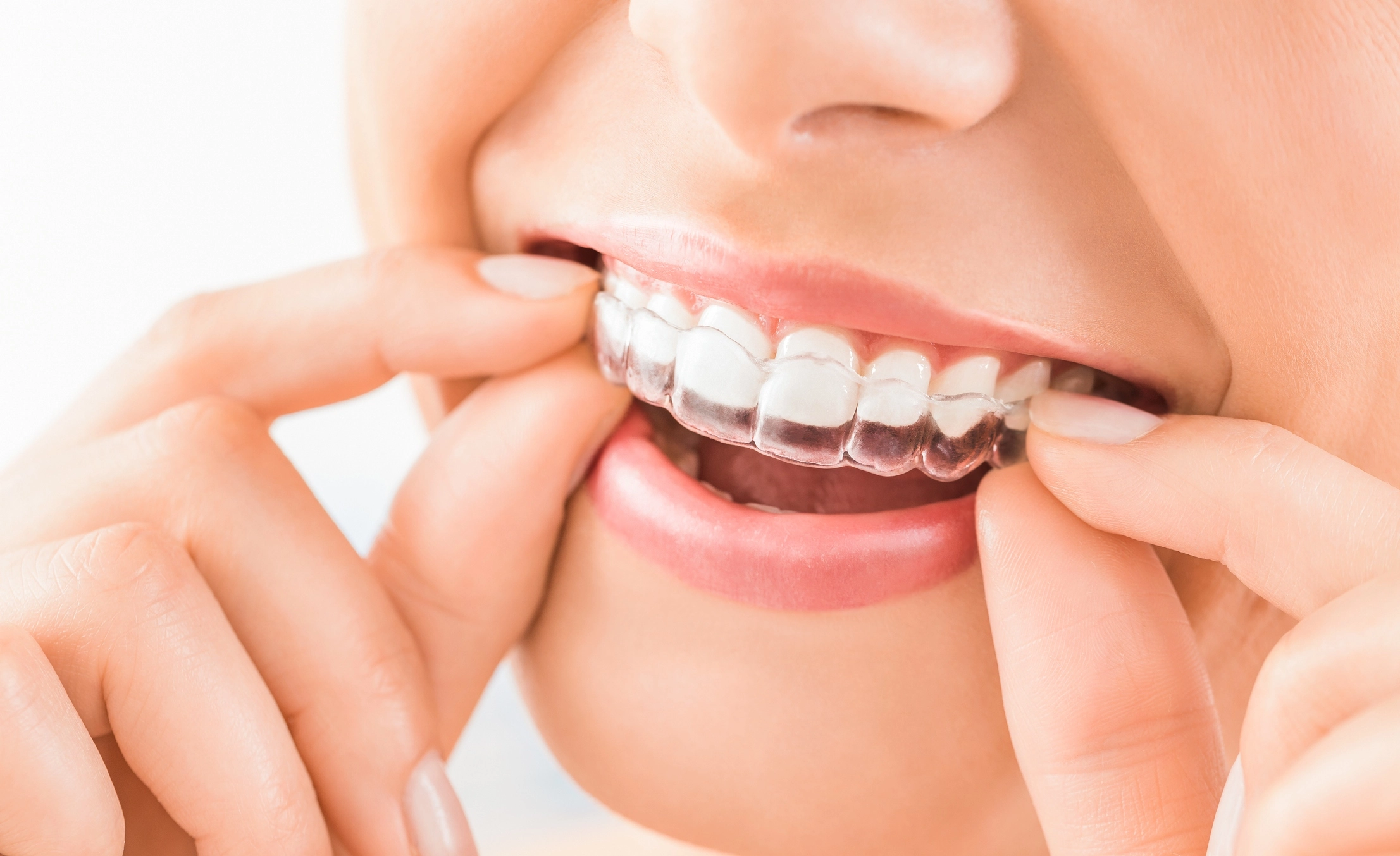 Advantages & Disadvantages of Invisalign Treatmnent