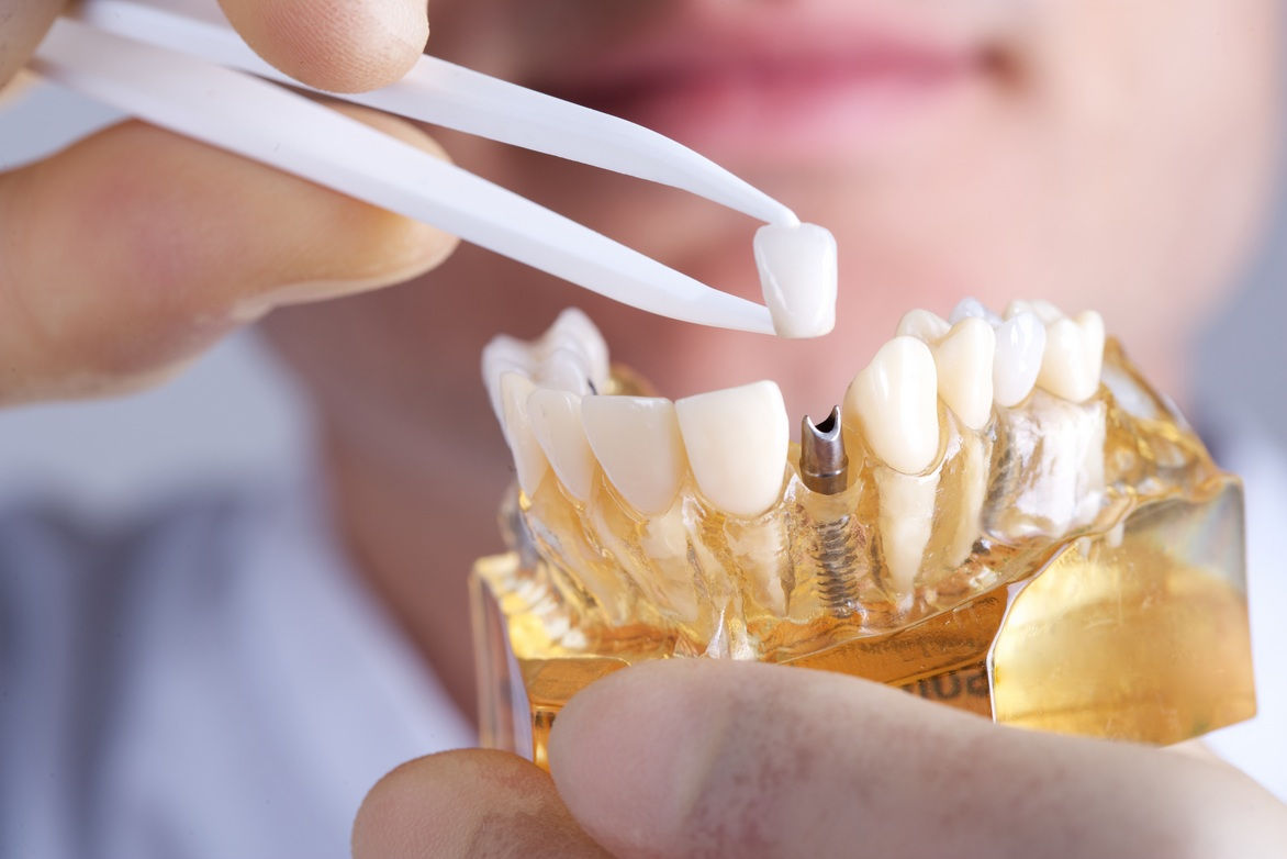 Types of Dental Implants and Benefits