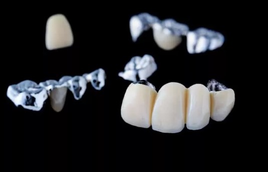 Complete Overview of Dental bridges