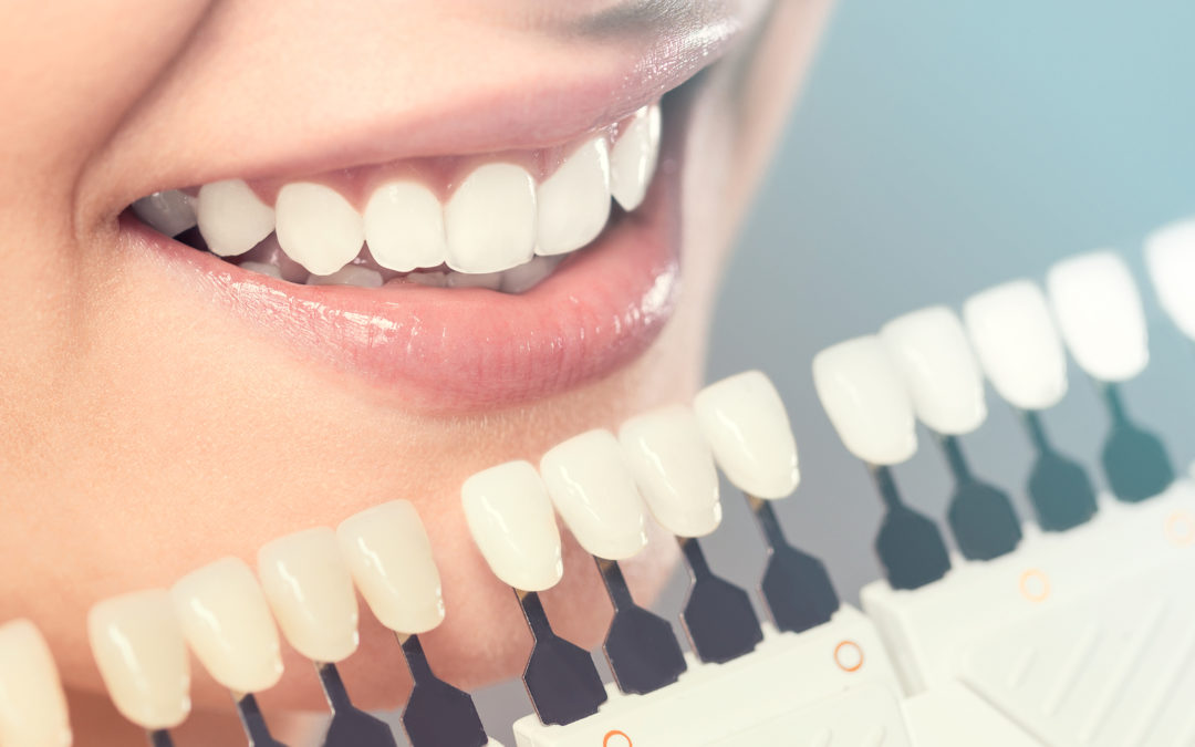 The Pros & Cons of Porcelain Veneers
