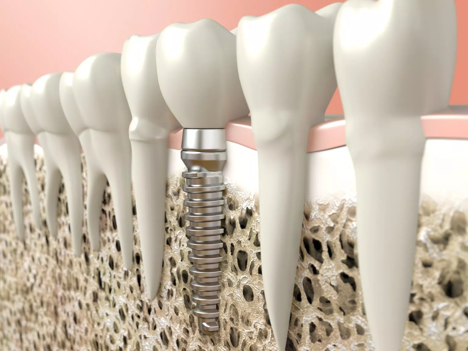 Things You Should Know Before Replacing Your Missing Teeth with Dental Implants