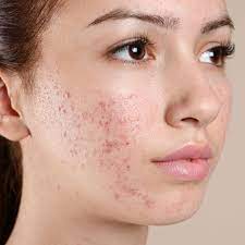 Understanding Post-Inflammatory Hyperpigmentation (PIH) and Acne Scars