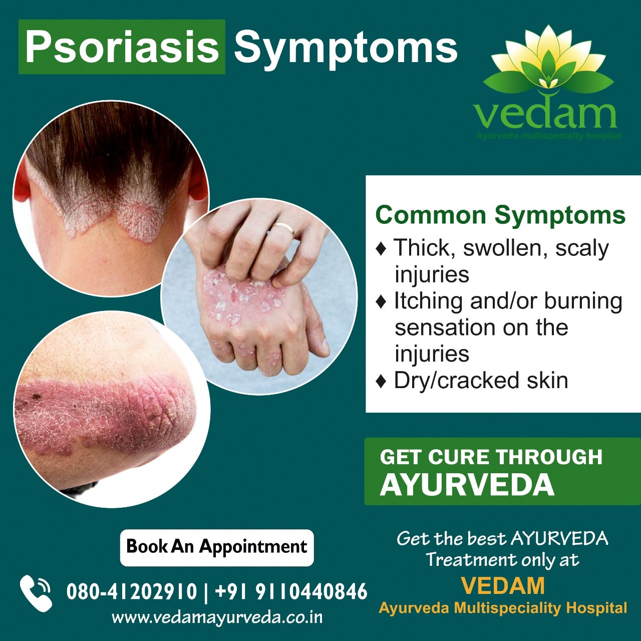 How to Treat Skin Psoriasis Ayurvedic Treatment?