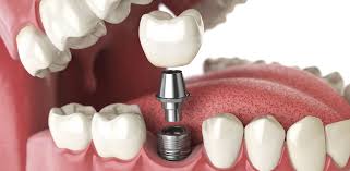 What is the Recovery Time for a Dental Implant?