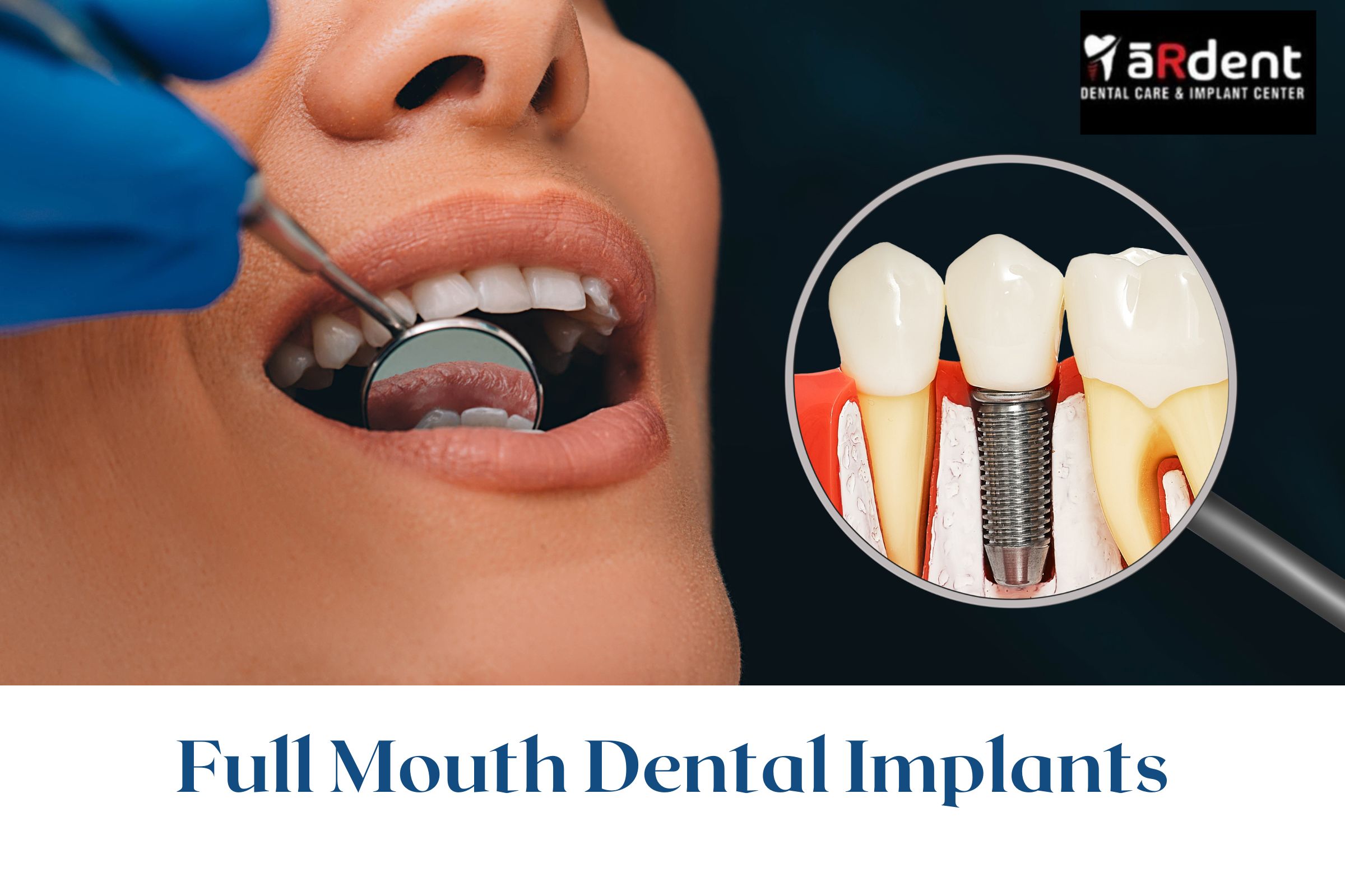 Understanding The Full Mouth Dental Implants Process A Step-By-Step Guide