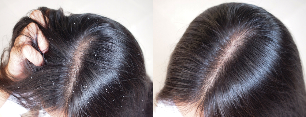 Say Goodbye to Hair Dandruff with These Proven Treatment Methods