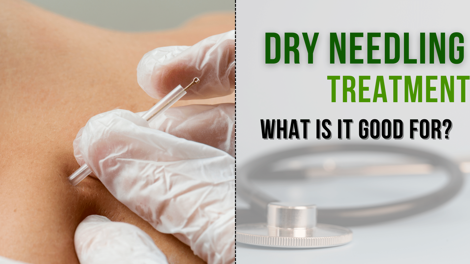What is Dry Needling and What is it good for?