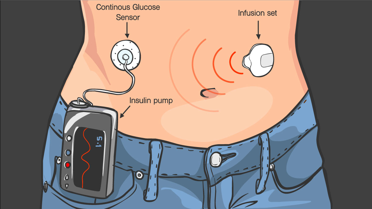 Global Tubeless Insulin Pump Market 2022 - Top Key Players Analysis Report Till 2028