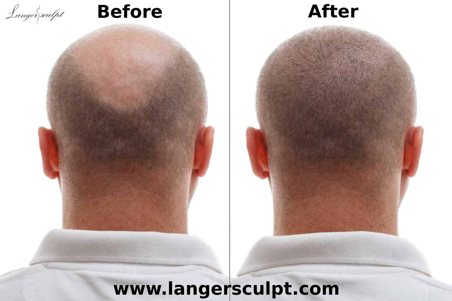 Who is the best hair transplant surgeon in India?