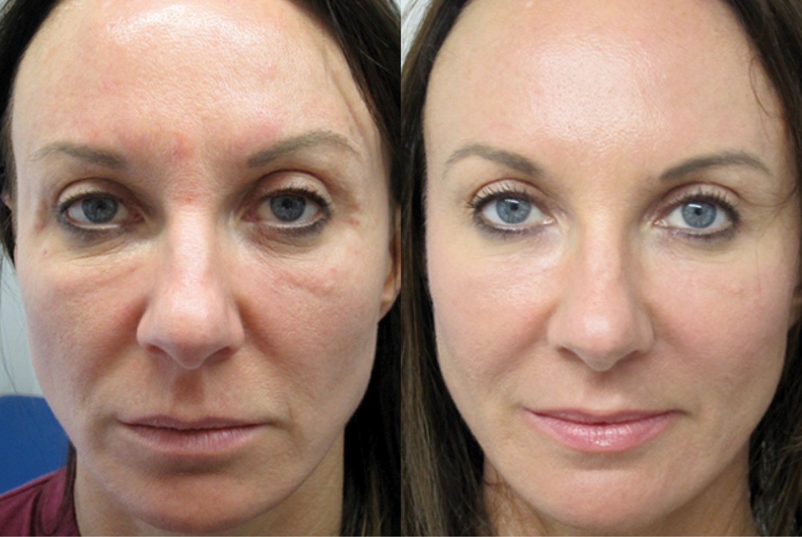 Revitalize Your Face and Breasts with Vampire Aesthetics