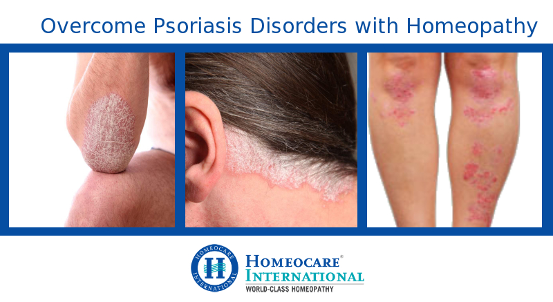 Homeopathy Treatment for Psoriasis