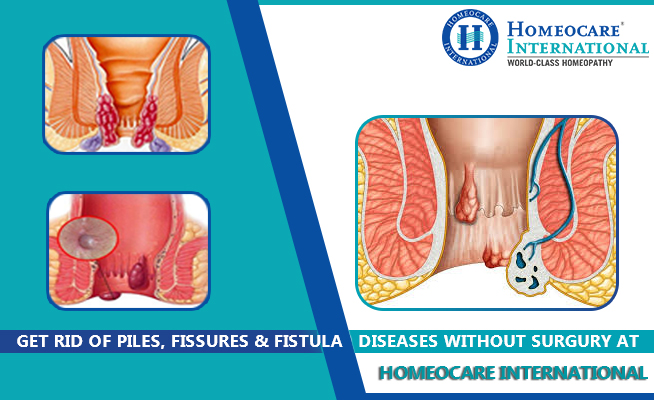 Piles treatment in homeopathy