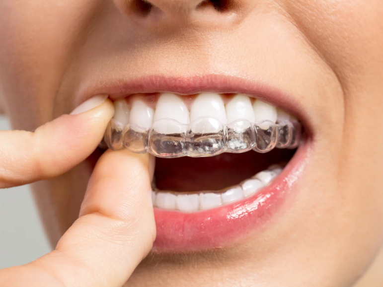 From Consultation to Completion: Invisible Braces Cost Guide